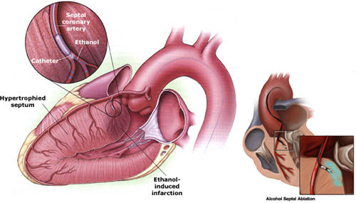 AlcoholAblation