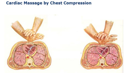 CardiacMassage
