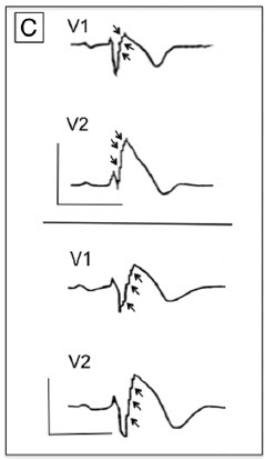 QRS fragmentation