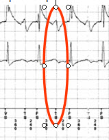 T wave oversensing